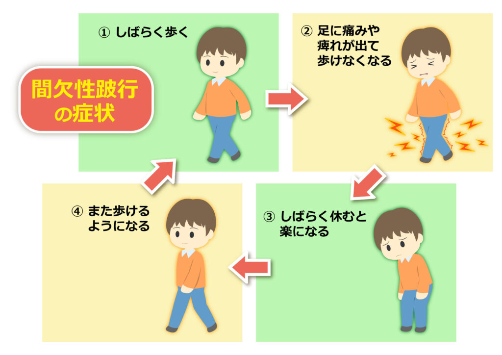 間欠跛行について